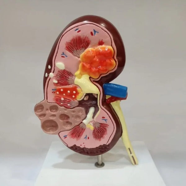 Kidney Cyst Model Delux