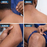 EACU acupuncture needles shown in clinical dry needling and therapy use