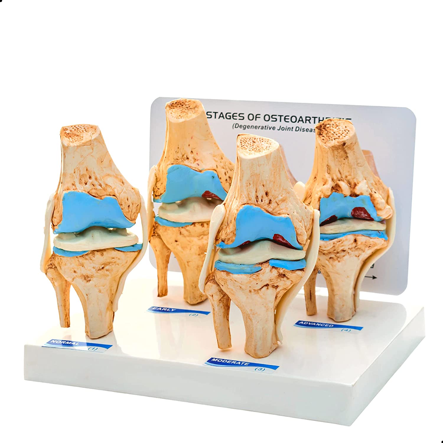 Knee Joint Arthritis Model 4 Stage Osteoarthritis